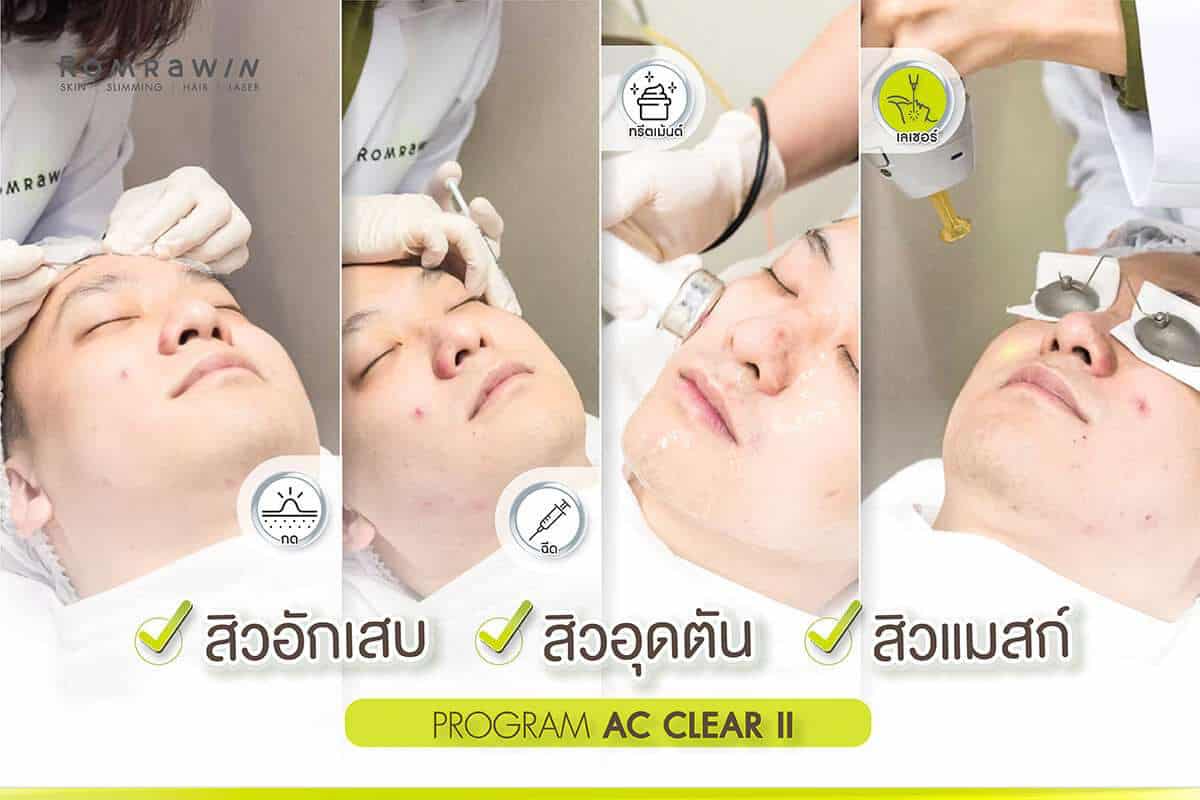 เลเซอร์สิวด้วย AC Clear ll