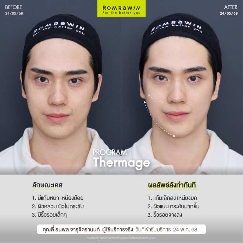 ผลลัพธ์ขึ้นอยู่กับแต่ละบุคคล