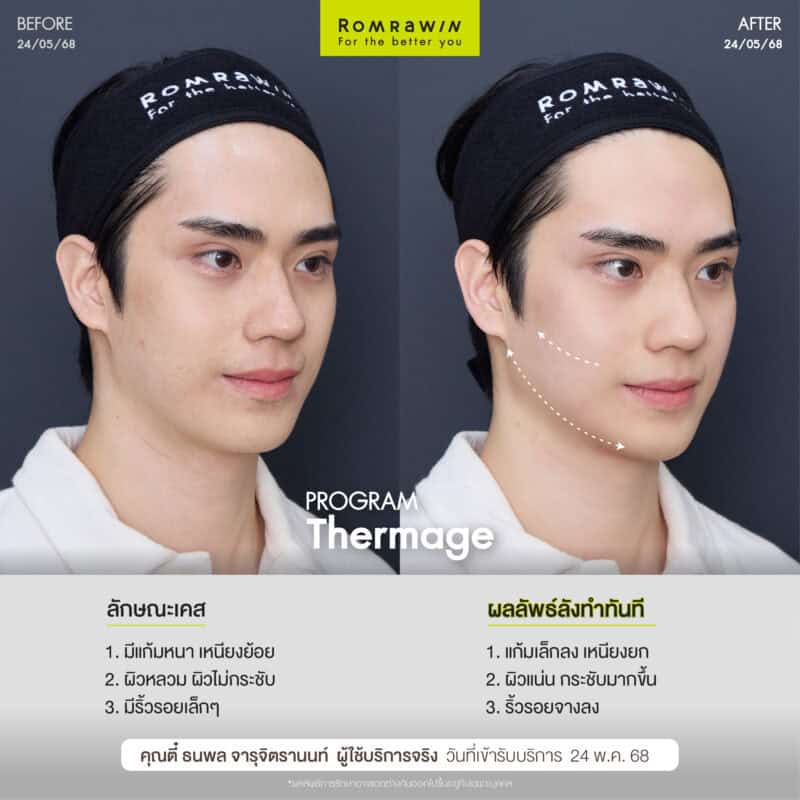 ผลลัพธ์ขึ้นอยู่กับแต่ละบุคคล
