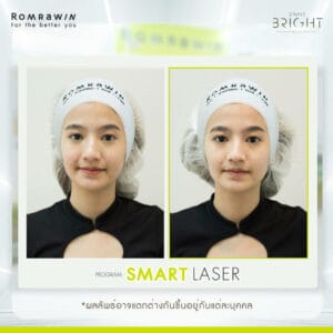 รักษารอยแดงจากสิว