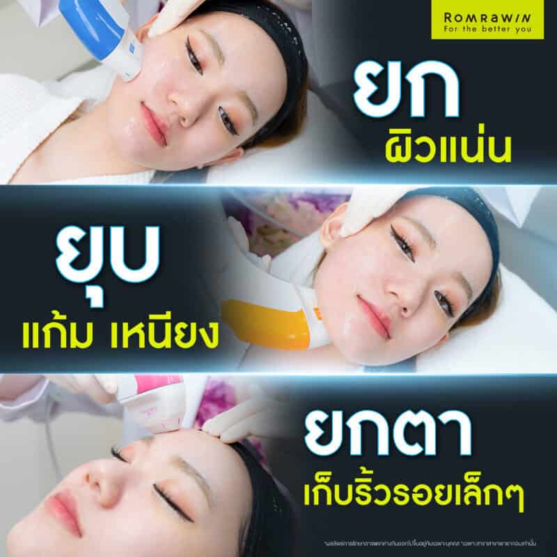 ผลลัพธ์ขึ้นอยู่กับแต่ละบุคคล