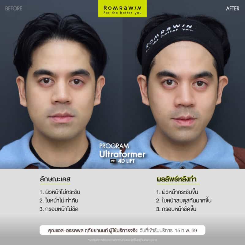 ผลลัพธ์ขึ้นอยู่กับแต่ละบุคคล