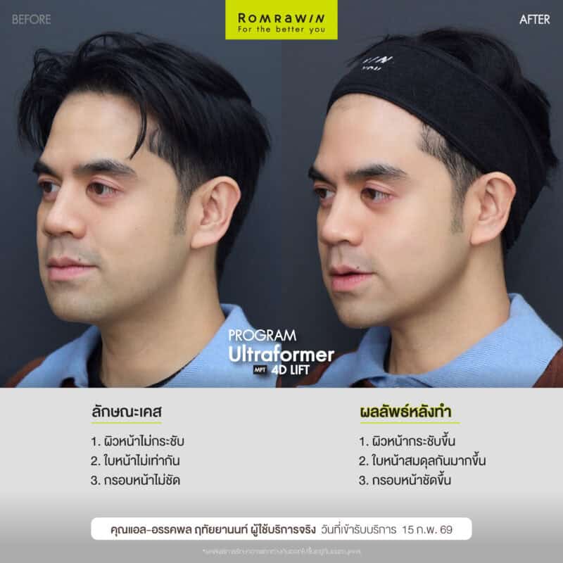 ผลลัพธ์ขึ้นอยู่กับแต่ละบุคคล
