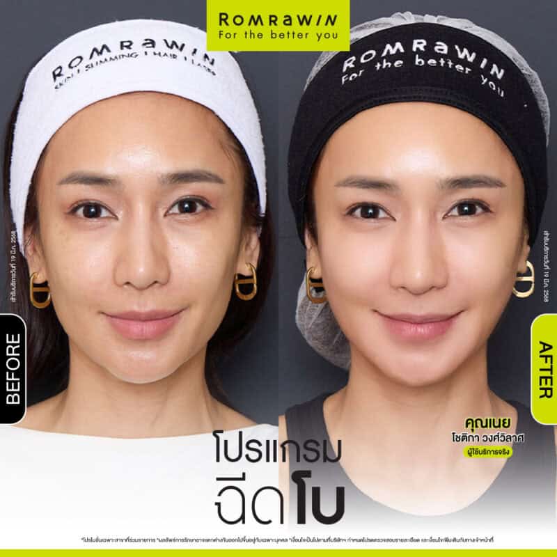 ผลลัพธ์ขึ้นอยู่กับแต่ละบุคคล