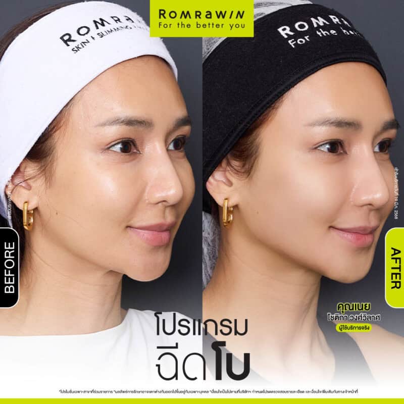 ผลลัพธ์ขึ้นอยู่กับแต่ละบุคคล