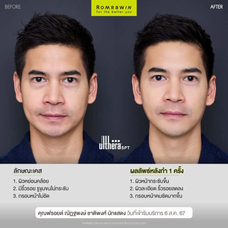 ผลลัพธ์ขึ้นอยู่กับแต่ละบุคคล