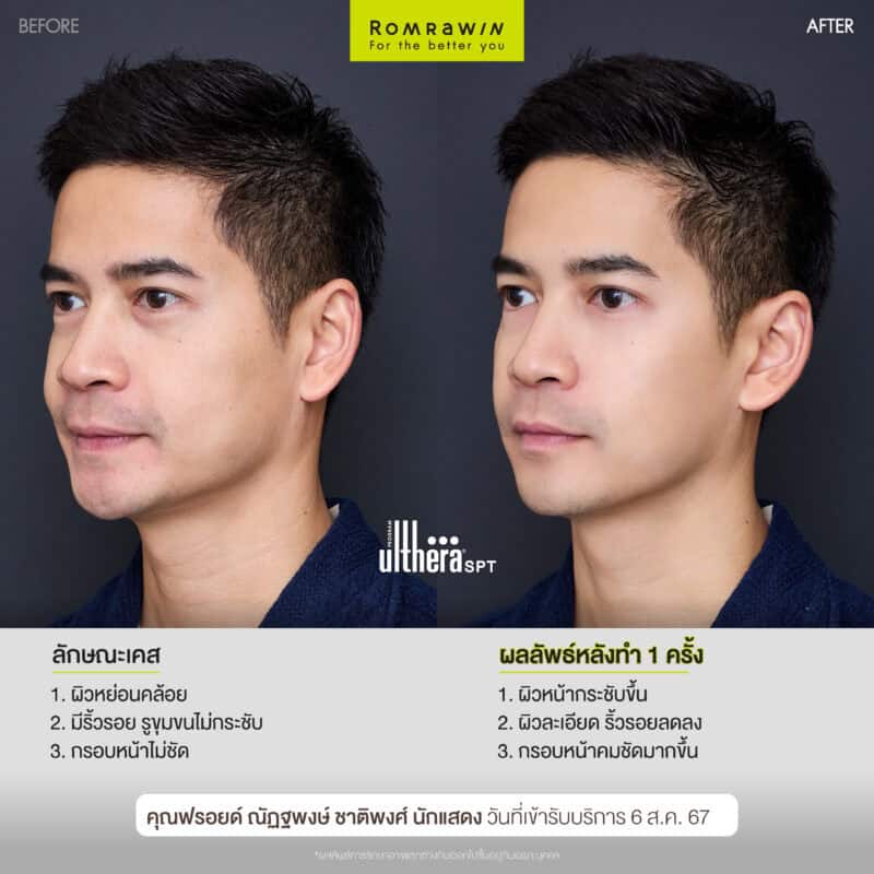 ผลลัพธ์ขึ้นอยู่กับแต่ละบุคคล