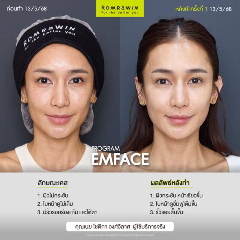 ผลลัพธ์ขึ้นอยู่กับแต่ละบุคคล