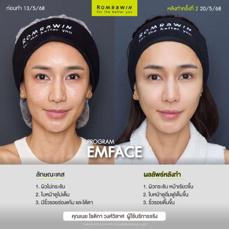 ผลลัพธ์ขึ้นอยู่กับแต่ละบุคคล