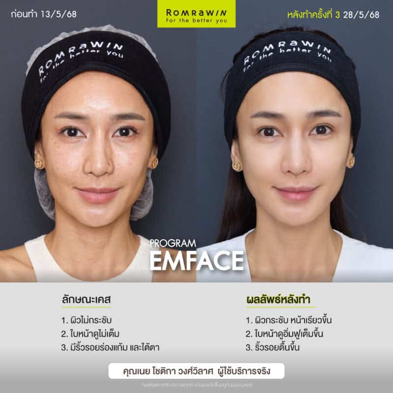 ผลลัพธ์ขึ้นอยู่กับแต่ละบุคคล