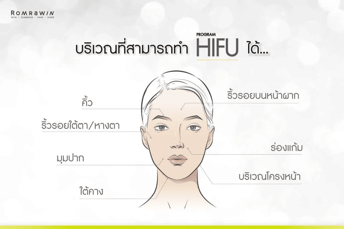 บริเวณที่สามารถทำ Hifu ได้