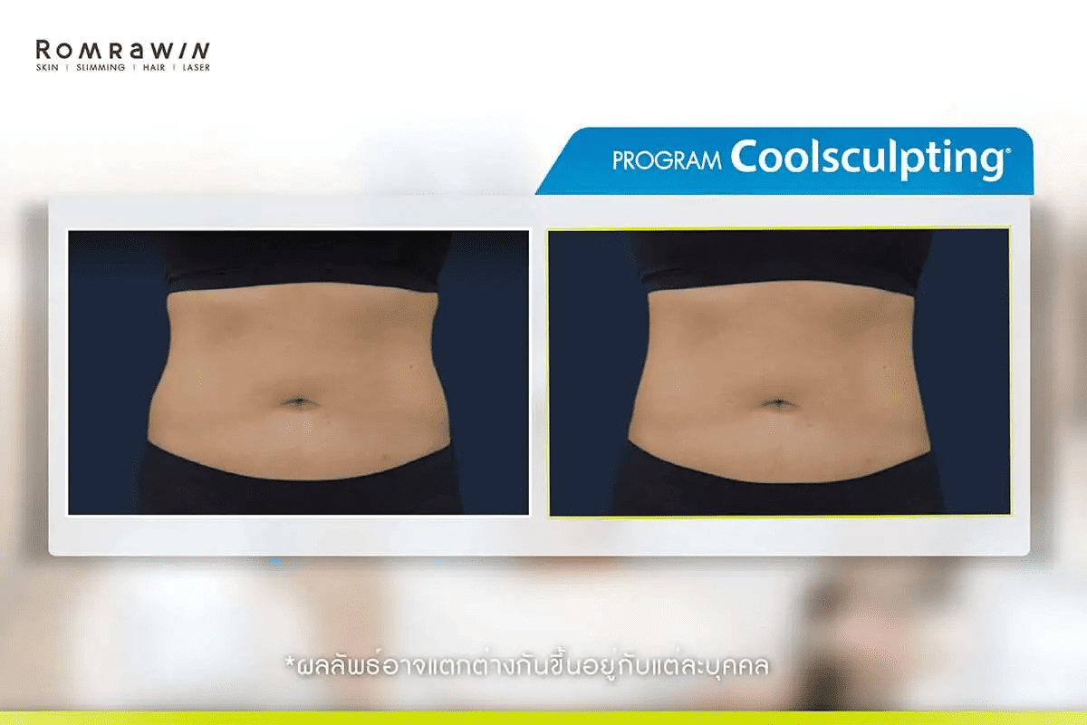 Coolsculpting ต้น ขา รีวิว