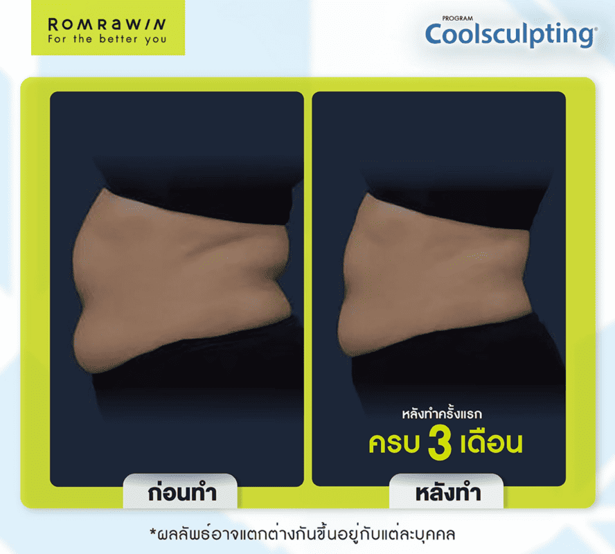 Coolsculpting หลังทำ