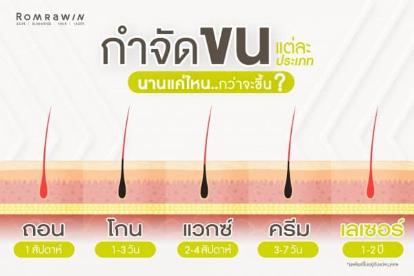เลเซอร์กำจัดขน