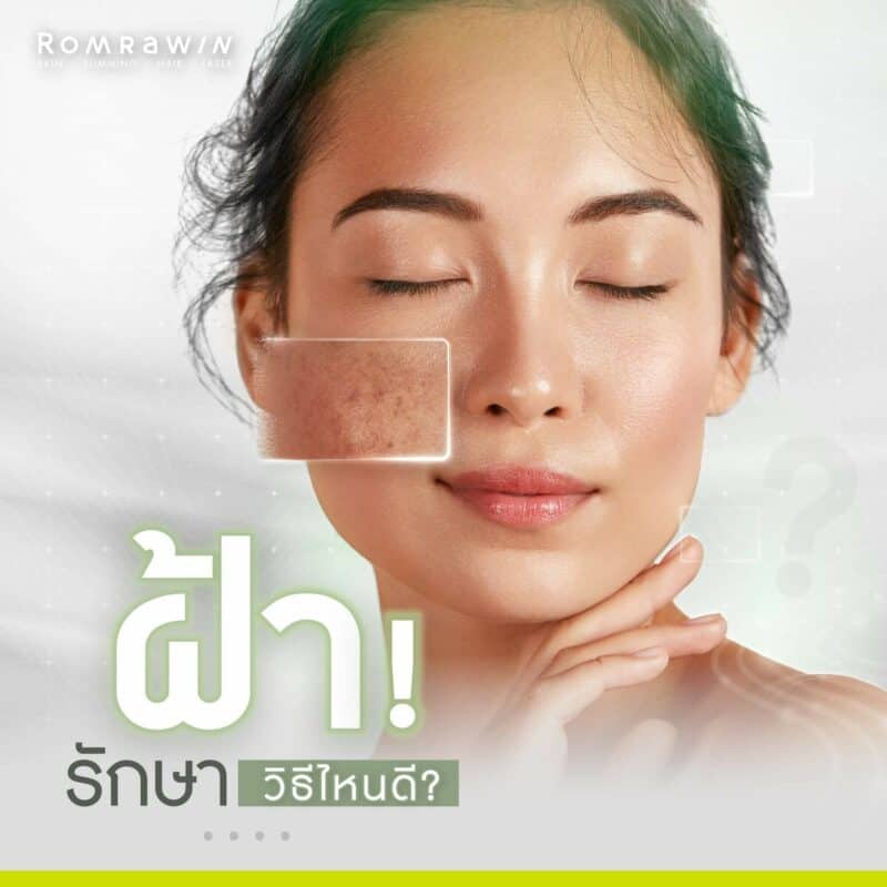 การรักษาฝ้า