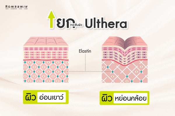ข้อสงสัย Ulthera