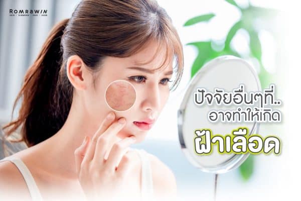 รักษาฝ้าเลือด