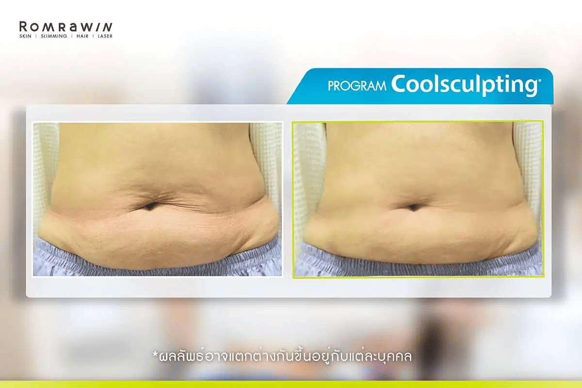 รีวิว Coolsculpting แขน