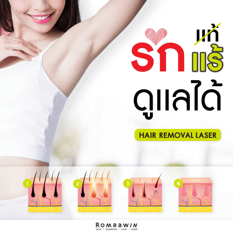 เลเซอร์รักแร้ราคา 