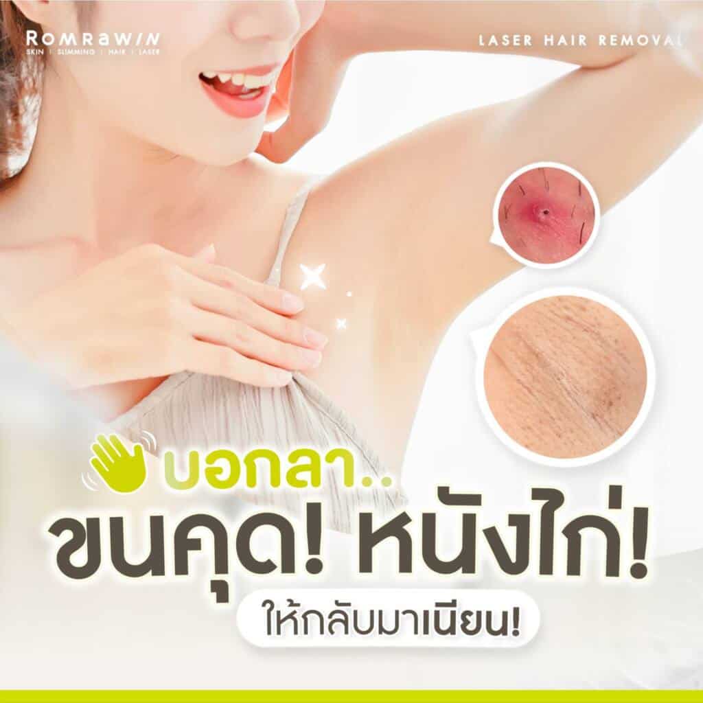 เลเซอร์หนวดเหมาะกับใคร