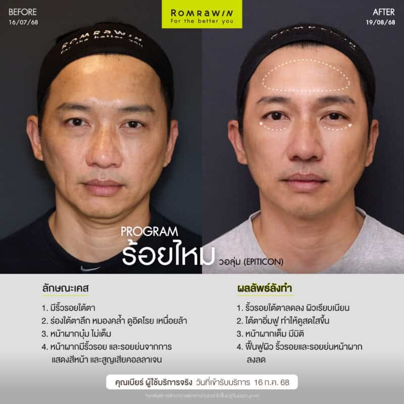 ผลลัพธ์ขึ้นอยู่กับแต่ละบุคคล