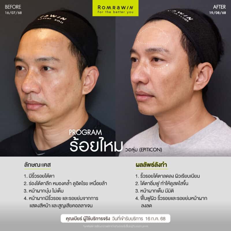 ผลลัพธ์ขึ้นอยู่กับแต่ละบุคคล