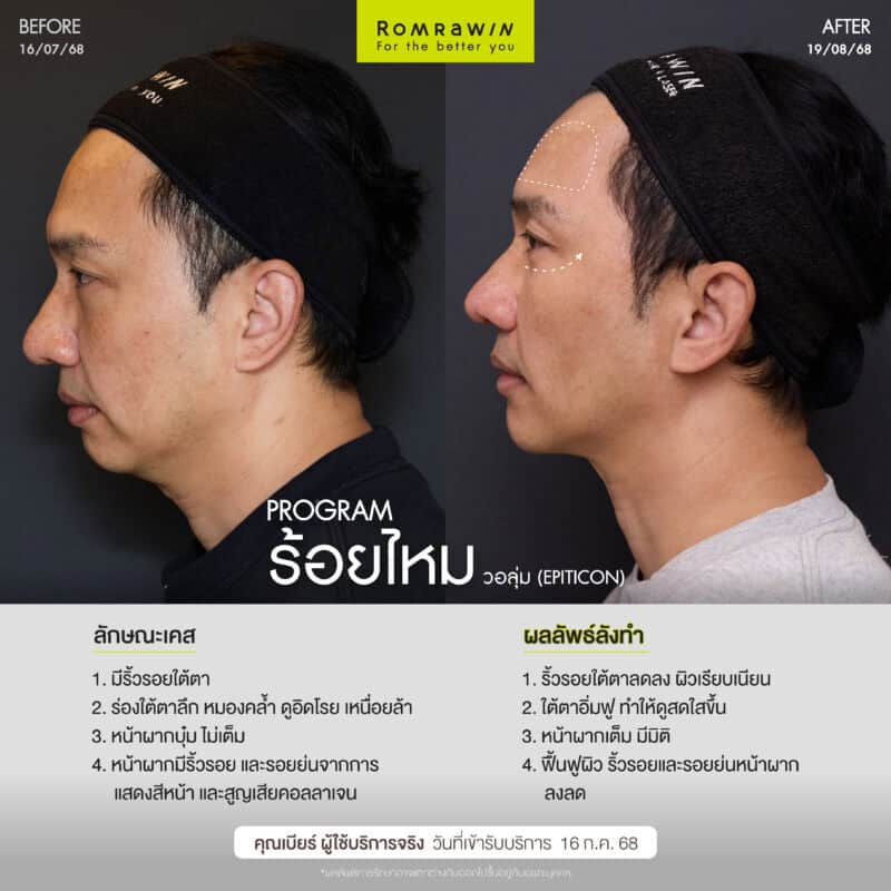 ผลลัพธ์ขึ้นอยู่กับแต่ละบุคคล