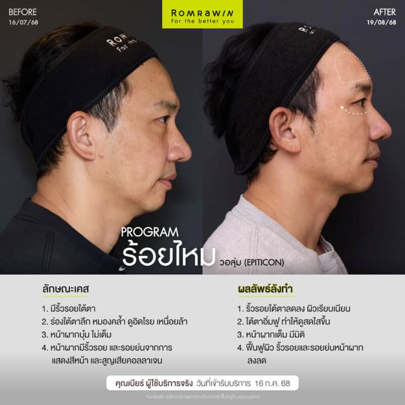 ผลลัพธ์ขึ้นอยู่กับแต่ละบุคคล