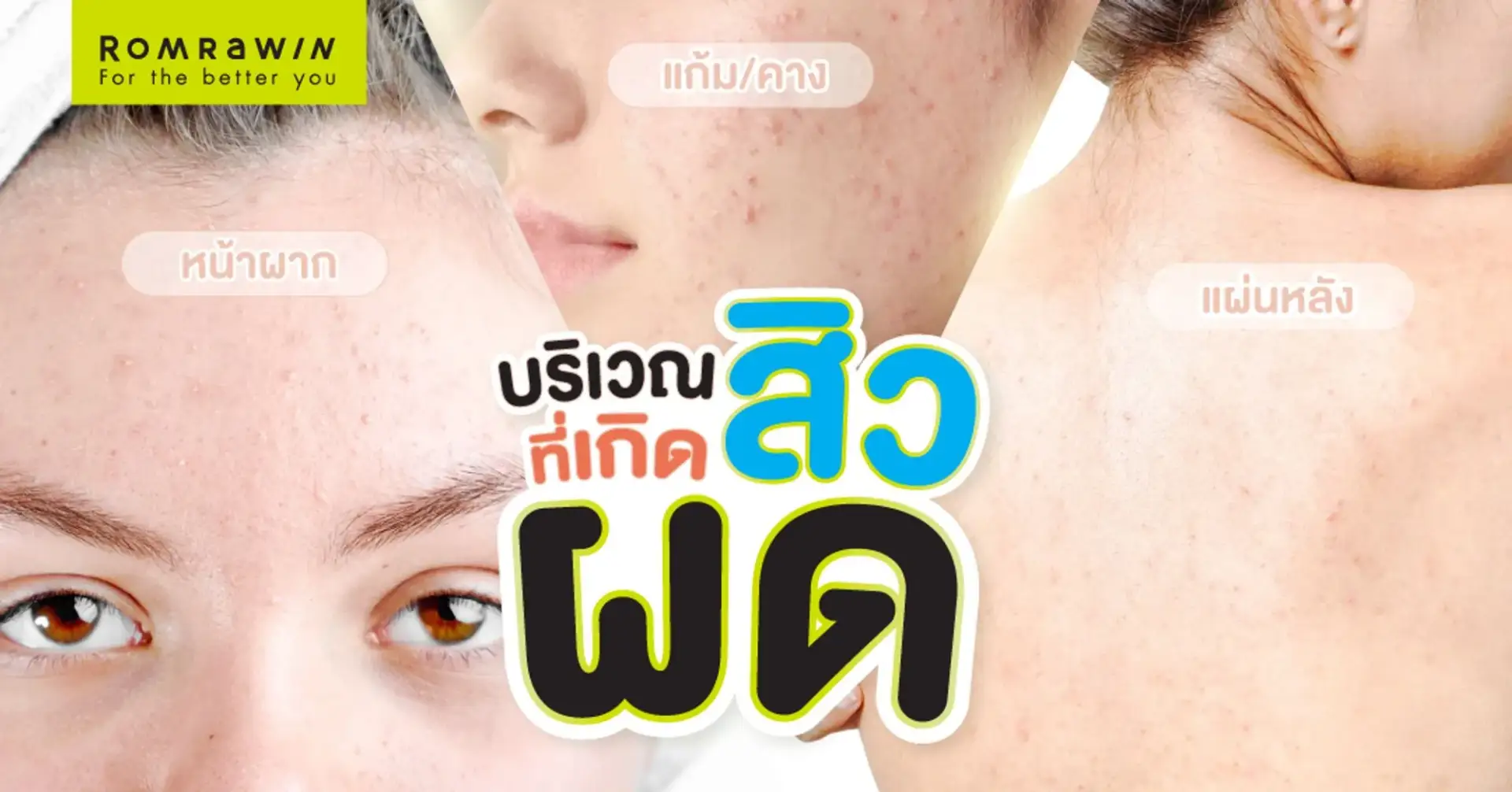 บริเวณที่เกิดสิวผด