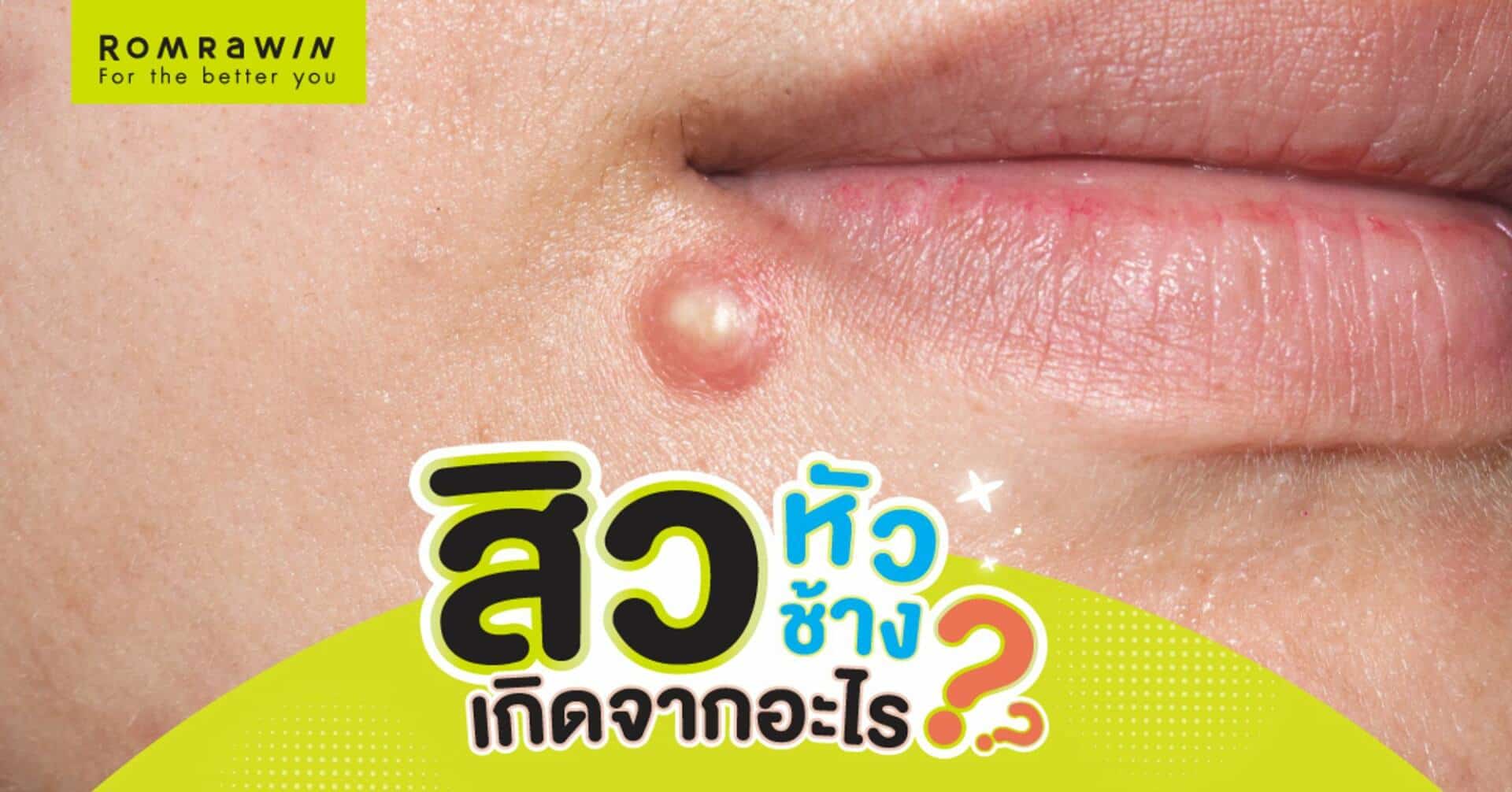 สิวหัวช้างเกิดจากอะไร