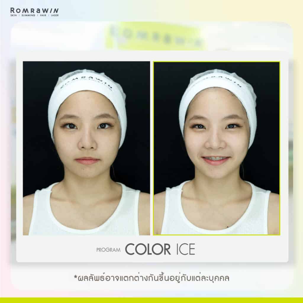 ทำทรีทเม้นท์หน้า