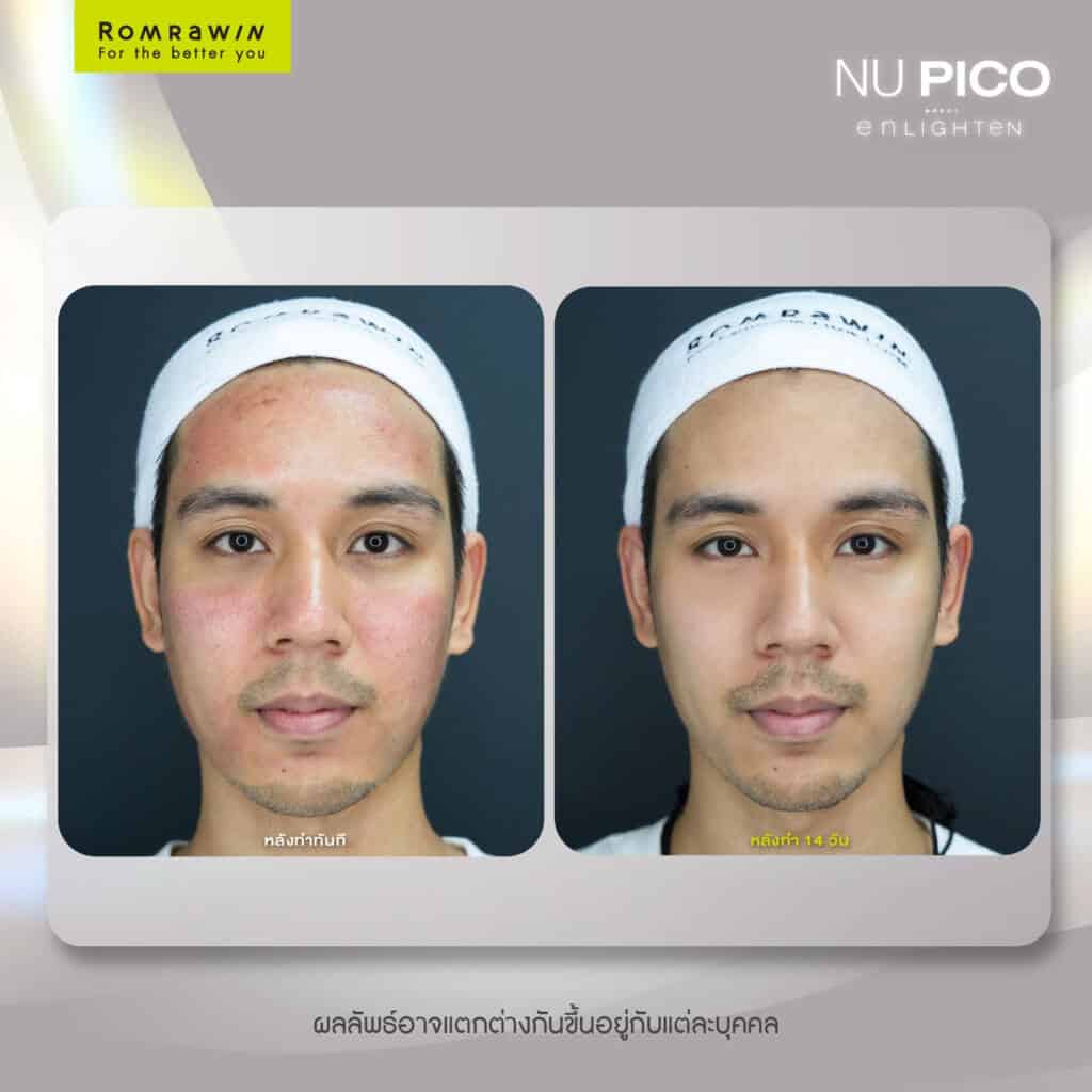 Pico laser รีวิว