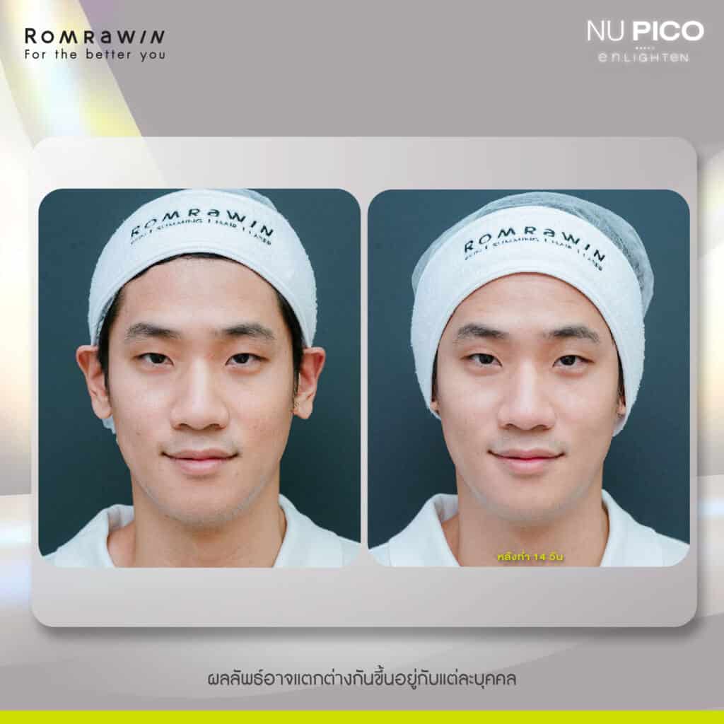 รมย์รวินท์คลินิก Pico laser รีวิว