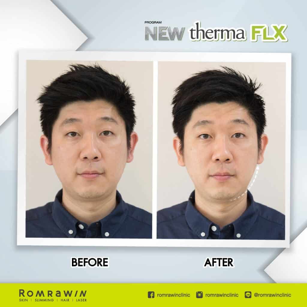 รีวิวยกกระชับหน้า thermage