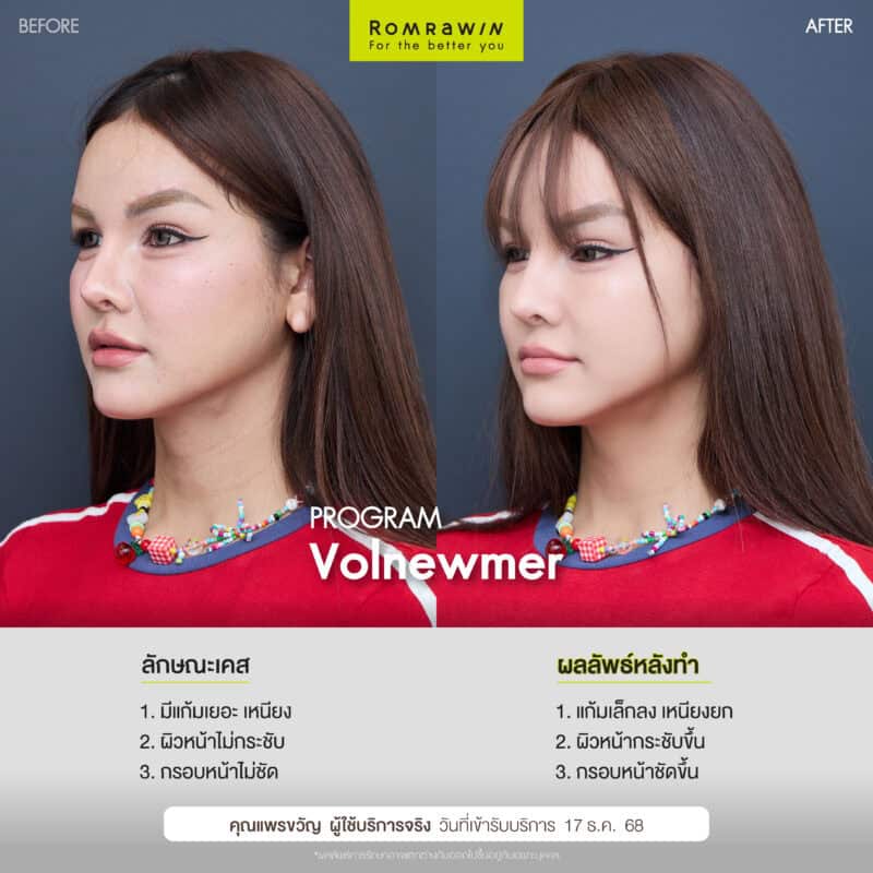 ผลลัพธ์ขึ้นอยู่กับแต่ละบุคคล