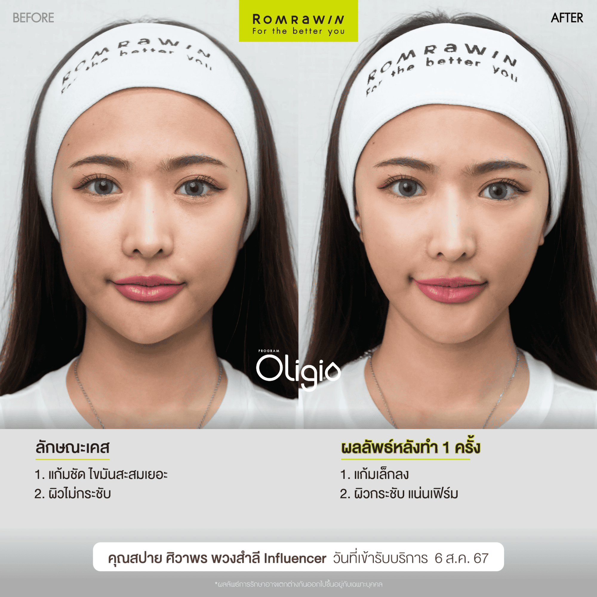 ผลลัพธ์ขึ้นอยู่กับแต่ละบุคคล