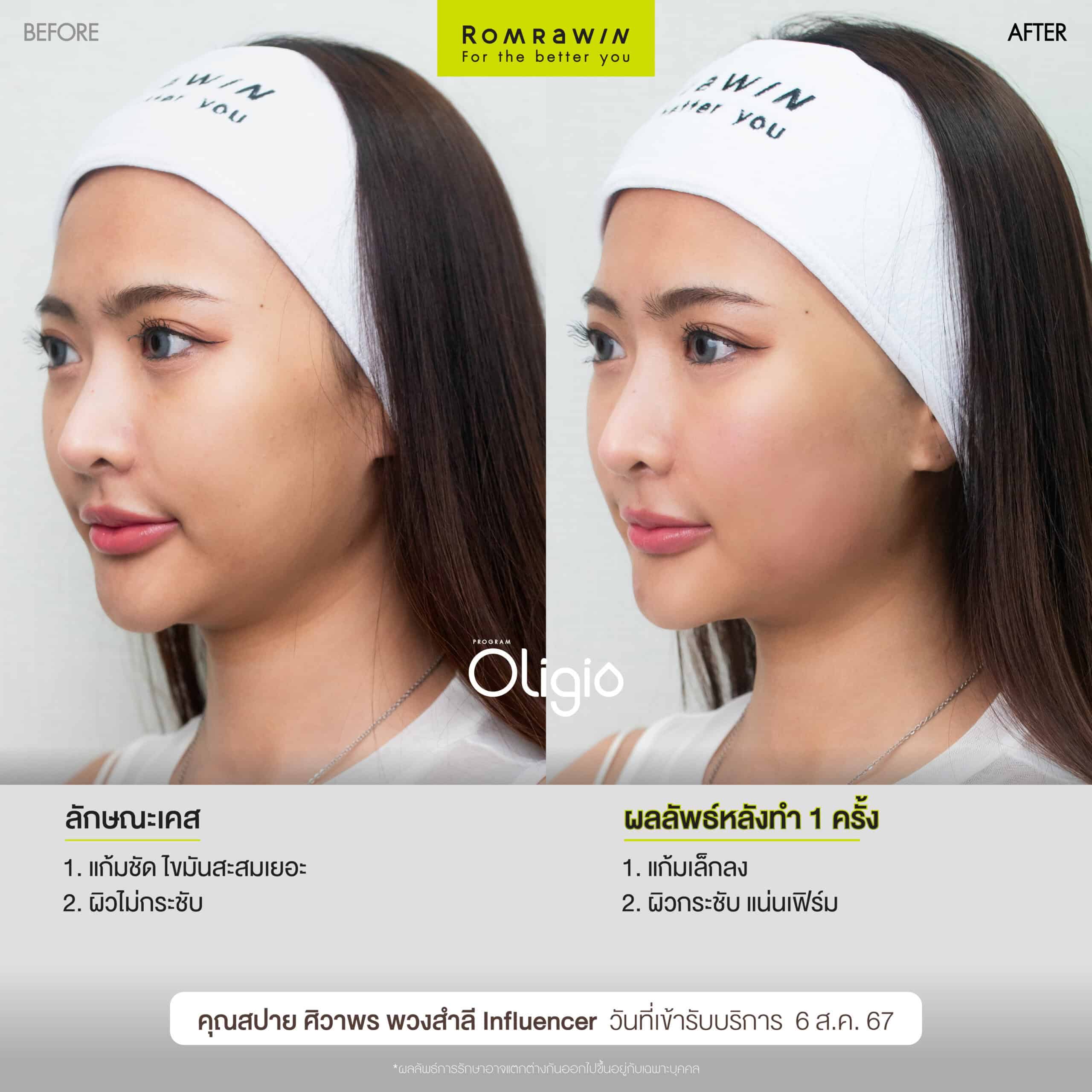 ผลลัพธ์ขึ้นอยู่กับแต่ละบุคคล