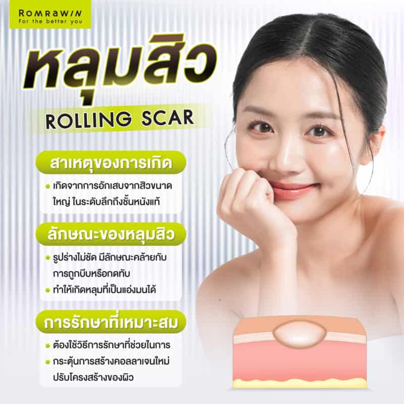 หลุมสิวแบบ Rolling Scar