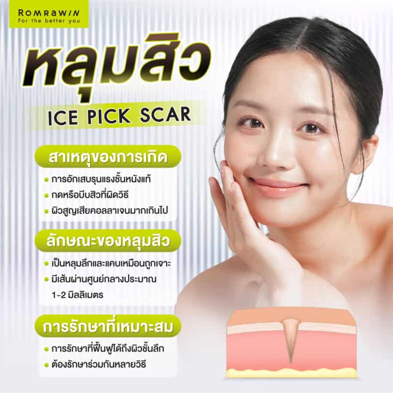 หลุมสิวแบบ Ice Pick Scar