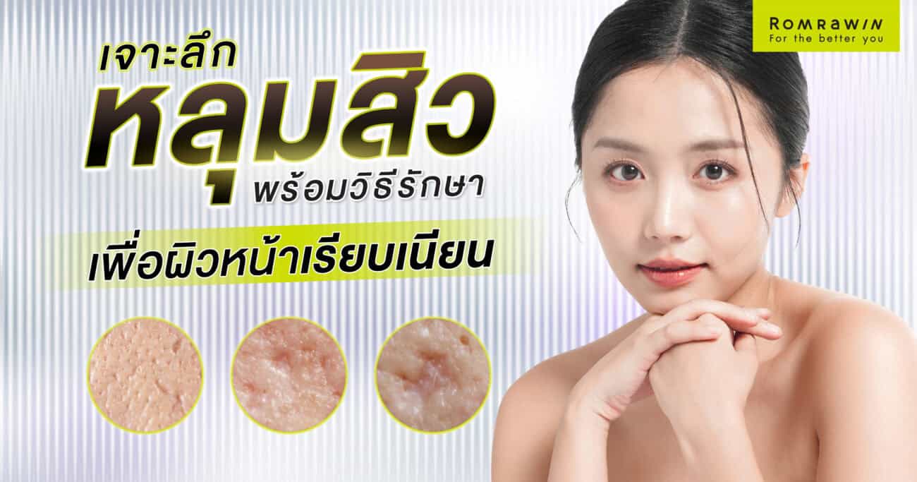 วิธีรักษาหลุมสิว