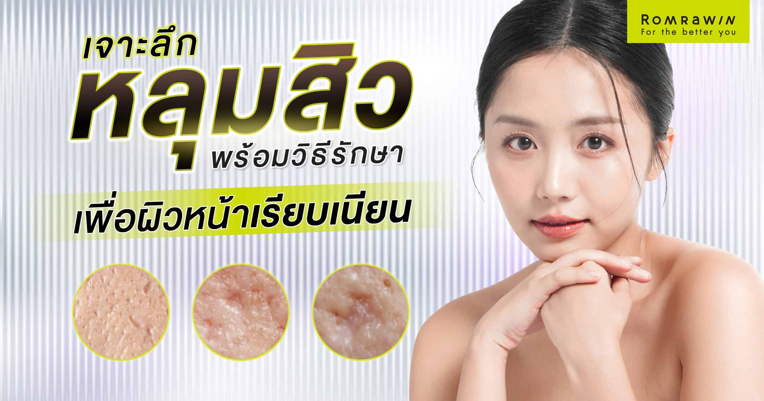 วิธีรักษาหลุมสิว