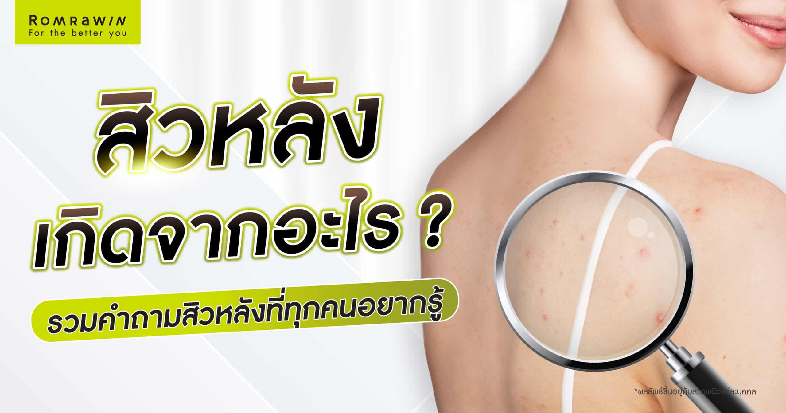 สิวที่หลัง