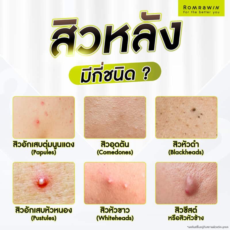 สิวที่หลังมีกี่ชนิด ?