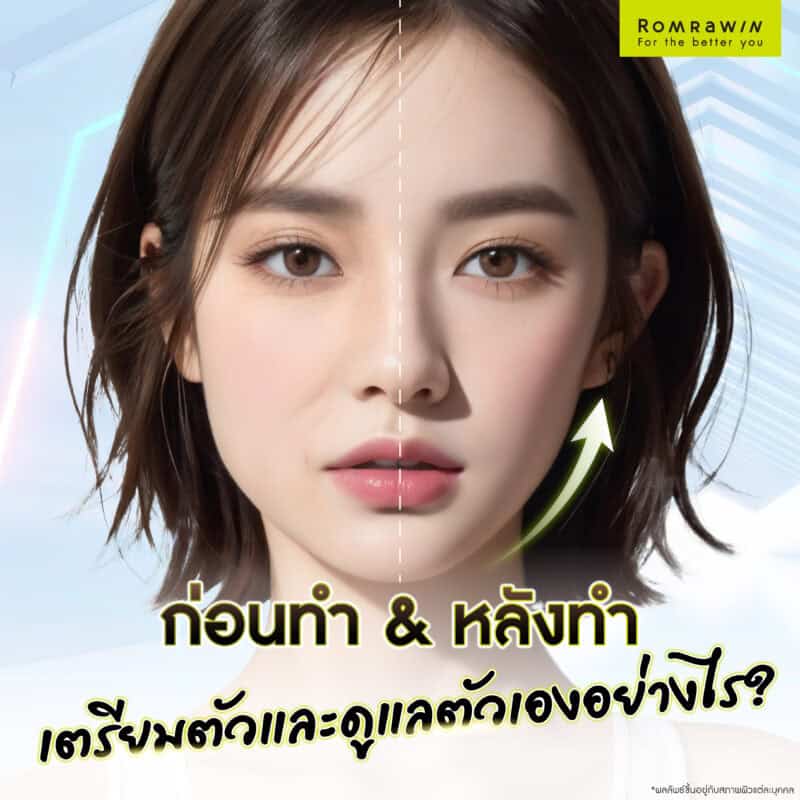 การเตรียมตัวก่อนทำ และการดูแลหลังทำยกกระชับผิวด้วย RF (Radio Frequency)