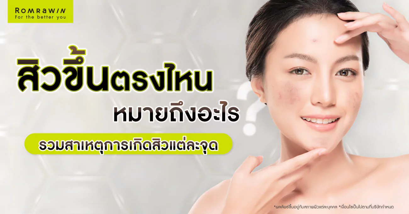 สิวขึ้นตรงไหนหมายถึงอะไร ?