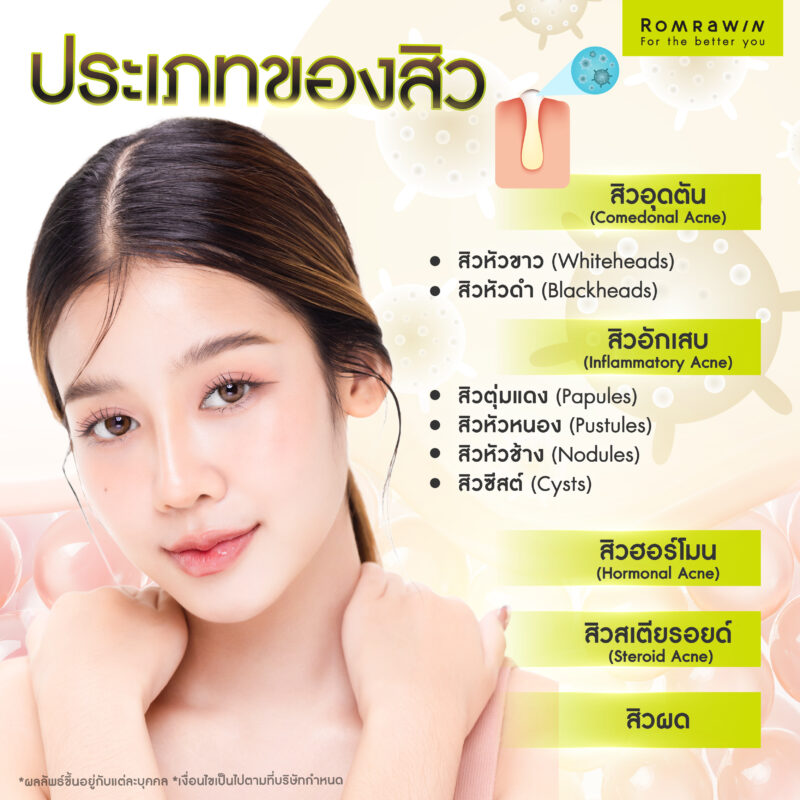 ประเภทของสิว