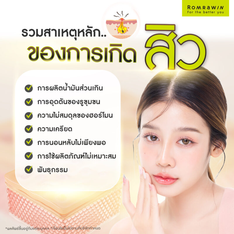 สิวเกิดจากอะไร ?