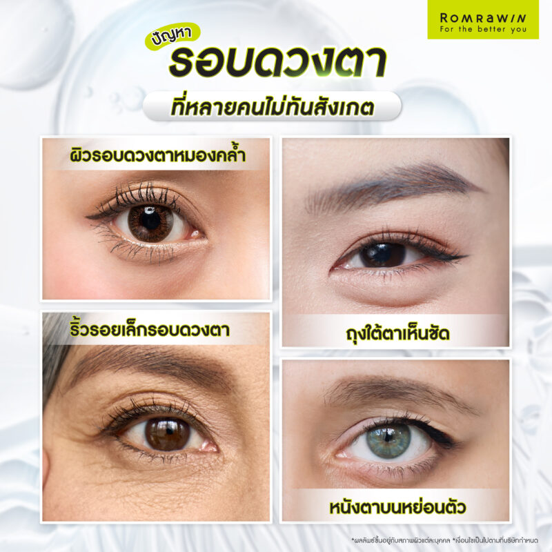 ปัญหารอบดวงตาที่หลายคนไม่ทันสังเกต
