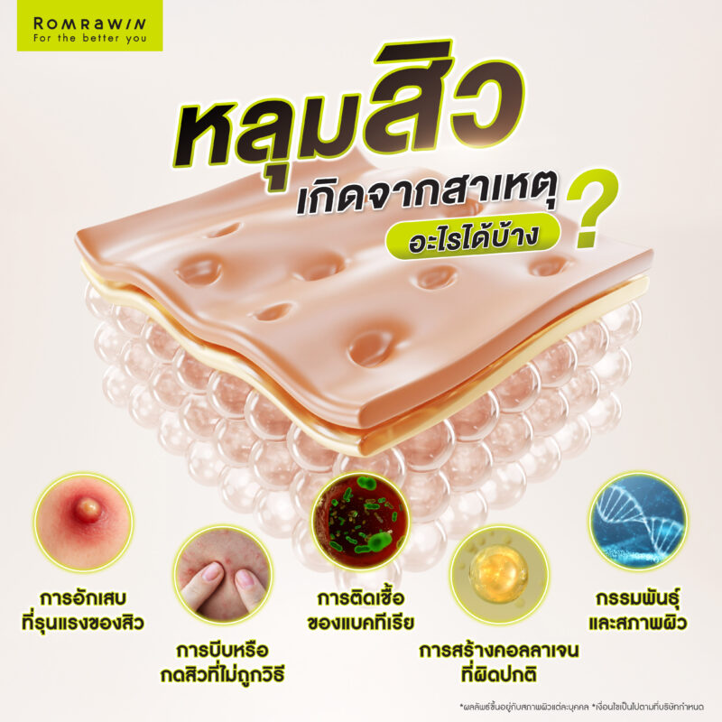 หลุมสิวเกิดจากสาเหตุอะไรบ้าง ?