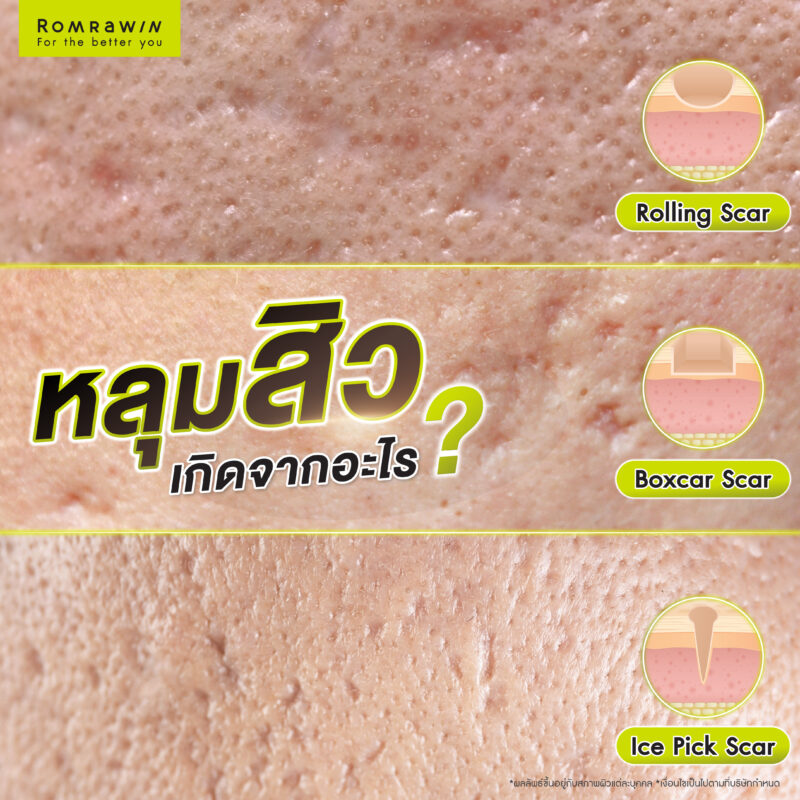 หลุมสิวมีกี่ประเภท ?